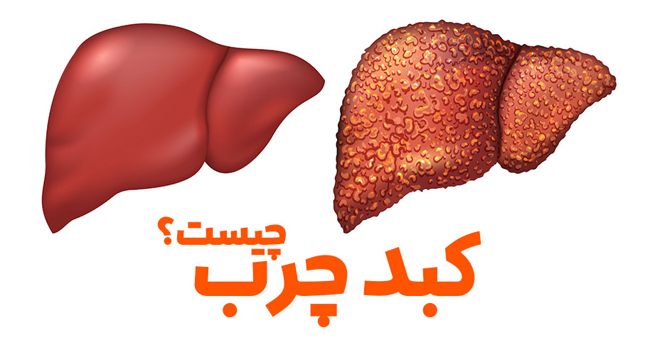 کبد چرب درجه ۱ تا ۳: تغذیه، ورزش، و خط قرمزها